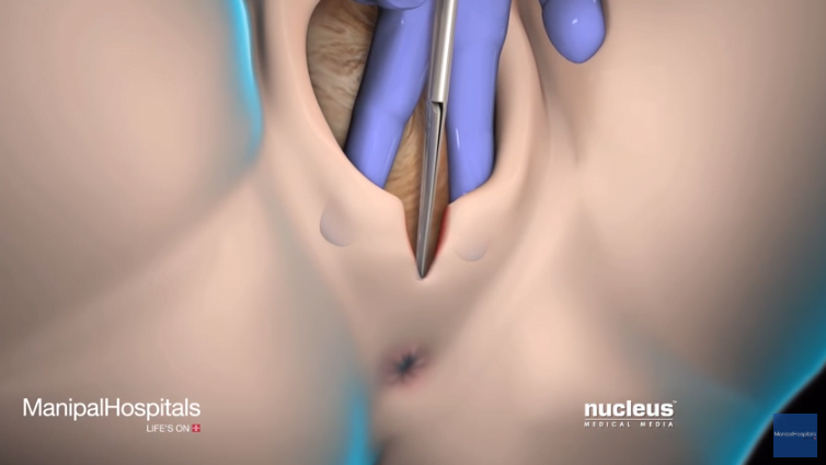 Epiziotomia - taierea perineului in timpul nasterii vaginale! Cum se face si cum poate fi evitata VIDEO | Demamici.ro