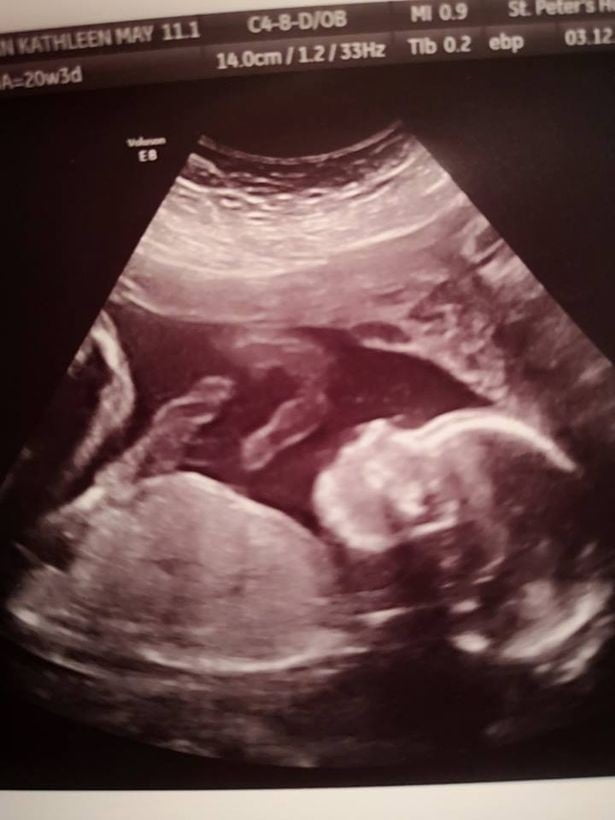 Copil nenascut, operat si pus inapoi in uterul mamei, in Marea Britanie | Demamici.ro